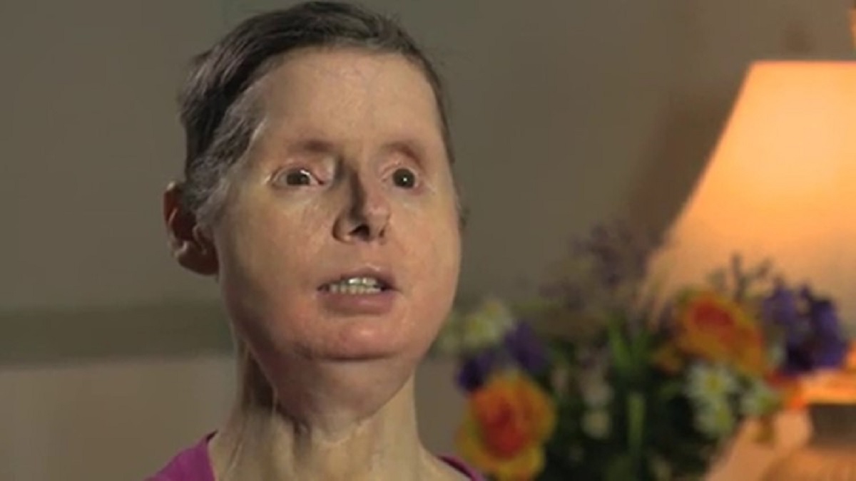 Where Is Charla Nash Now? Before And After Chimp Travis Attack Tech