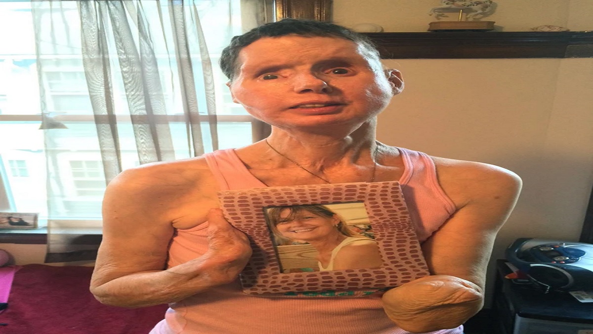 Where Is Charla Nash Now? Before And After Chimp Travis Attack Tech